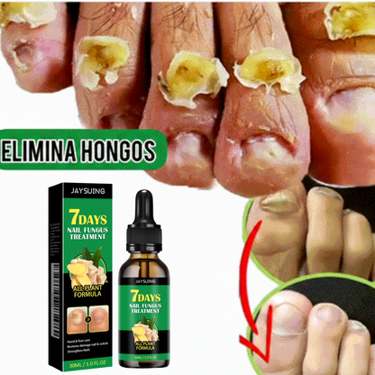 FungiStop® - Elimina el Hongo de tus uñas