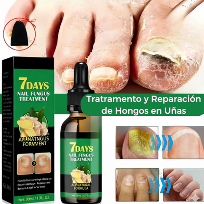 FungiStop® - Elimina el Hongo de tus uñas