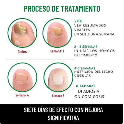 FungiStop® - Elimina el Hongo de tus uñas